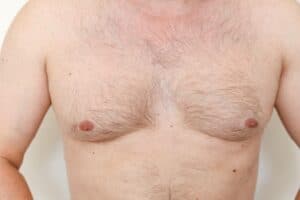 Gynecomastia Candidates San Antonio