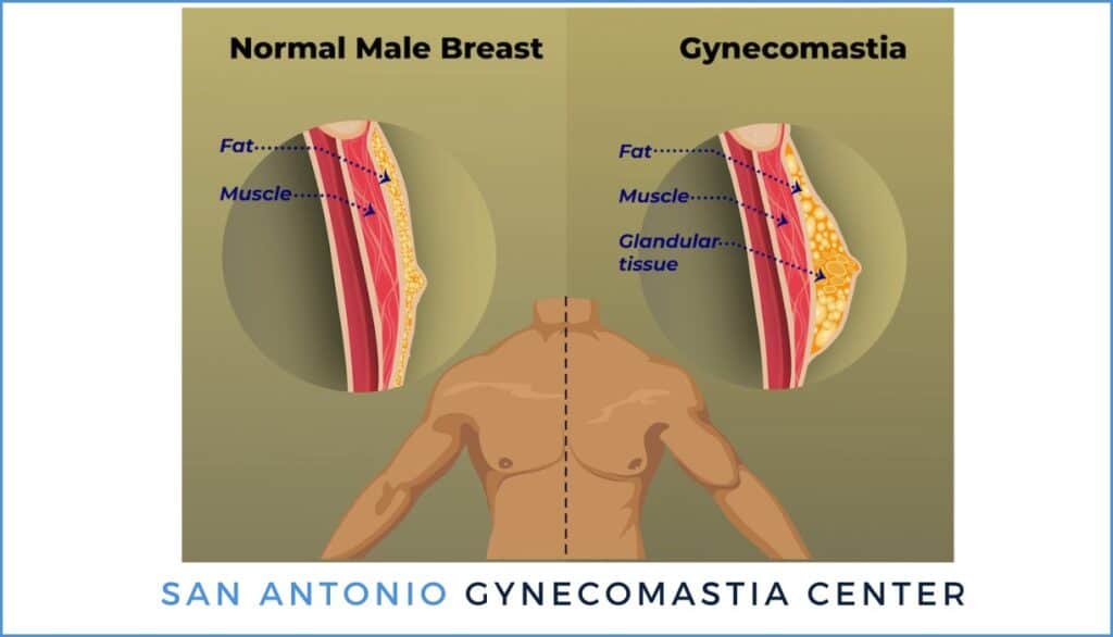 Gynecomastia San Antonio