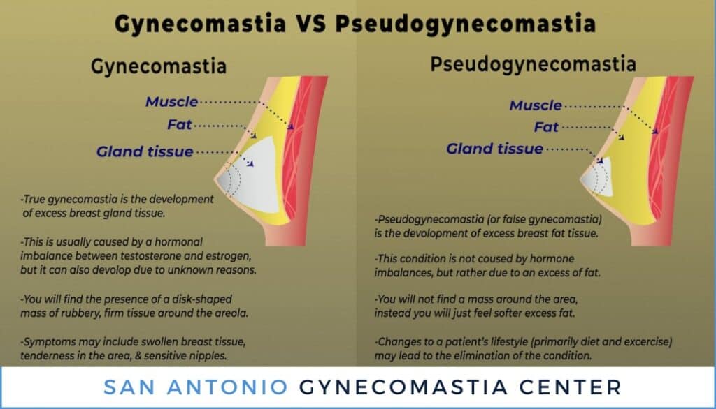 Pseudogynecomastia Surgery San Antonio