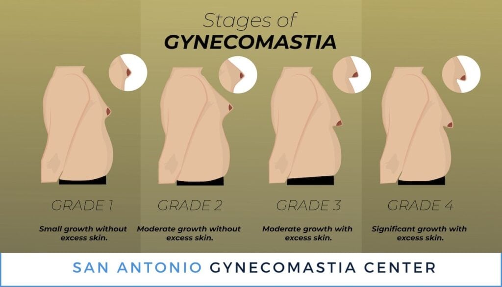 Stages Grades of Gynecomastia