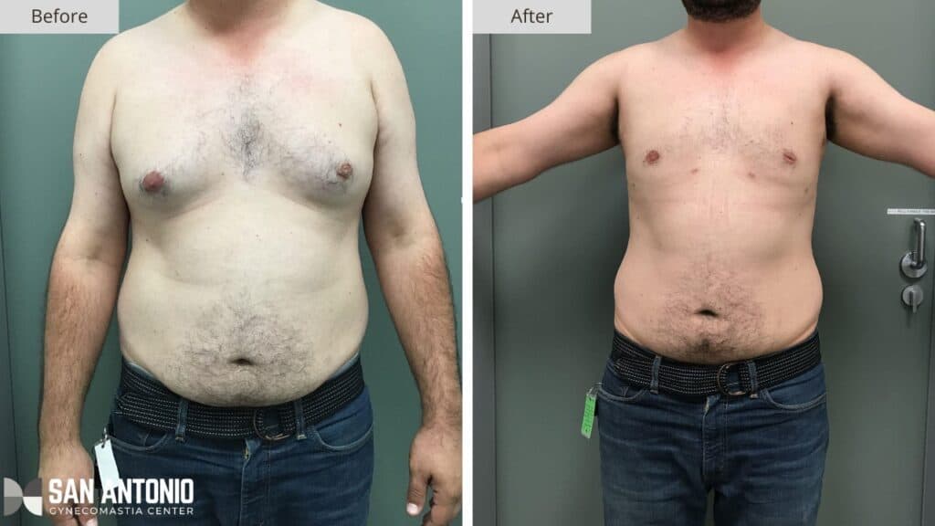 San Antonio Gynecomastia Before and After 1a