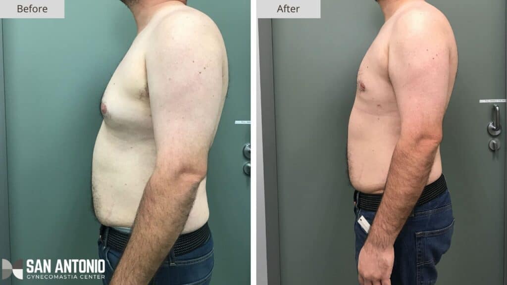 San Antonio Gynecomastia Before and After Photo3