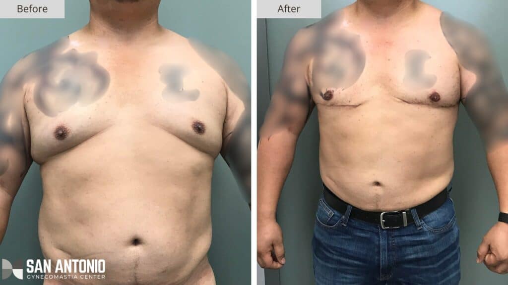 San Antonio Gynecomastia Before and After 2a