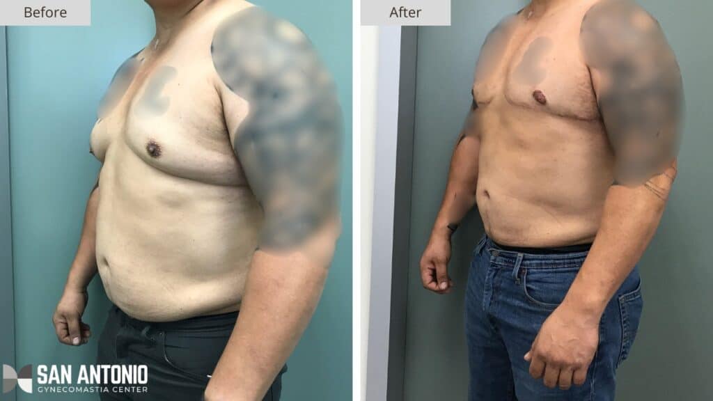 San Antonio Gynecomastia Before and After Photo4