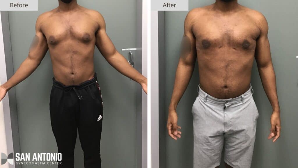 San Antonio Gynecomastia Before and After 3a