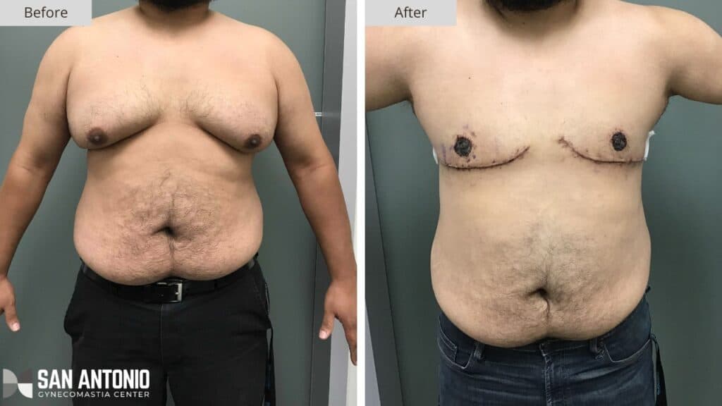 San Antonio Gynecomastia Before and After 4a