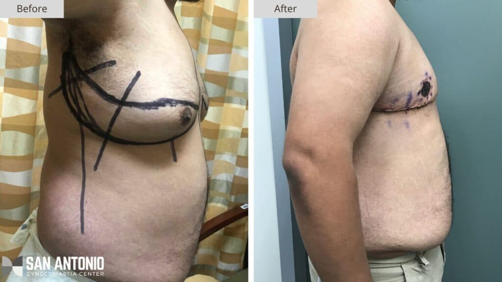 San Antonio Gynecomastia Before and After 4b