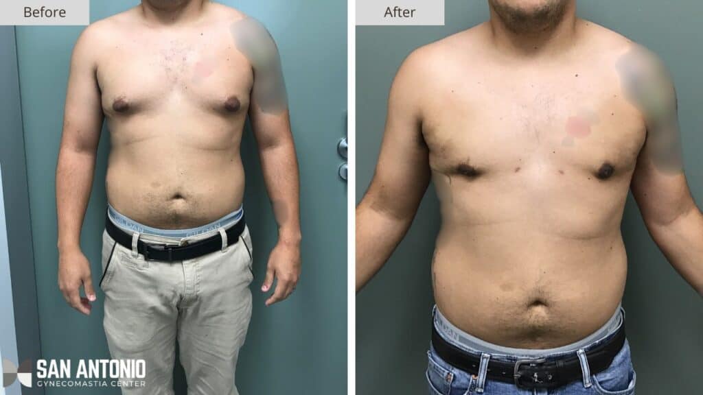 San Antonio Gynecomastia Before and After 5a