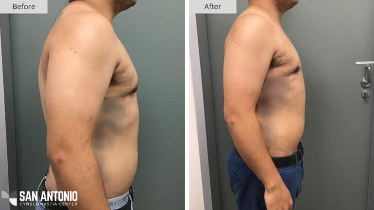 Stage 1 Gynecomastia Before and After Photo