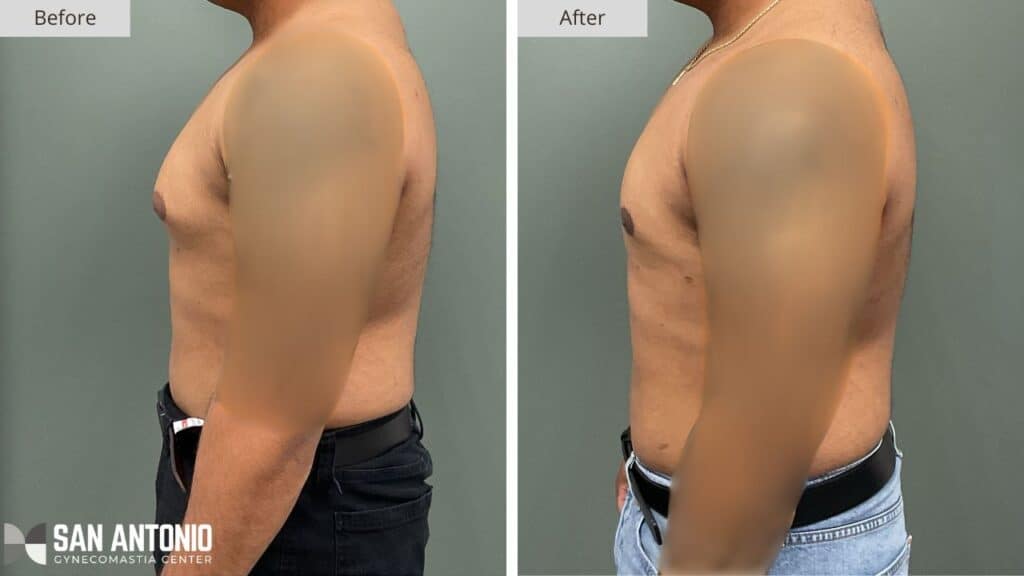 San Antonio Gynecomastia Center Before & After Grade 1 Patient