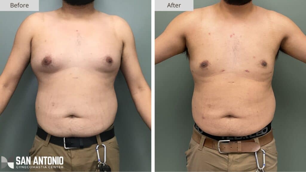 San Antonio Gynecomastia 7a