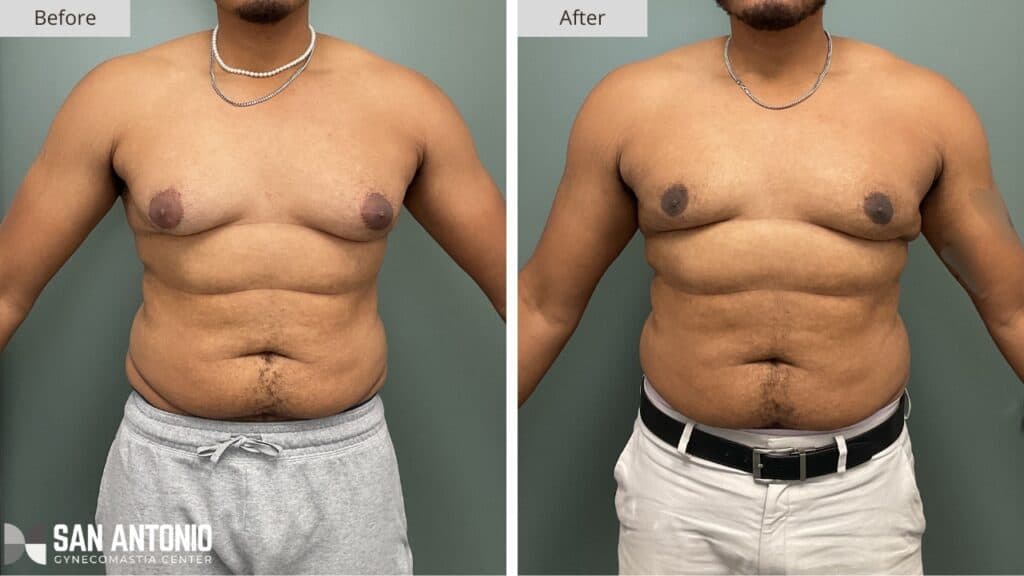 San Antonio Gynecomastia 8a