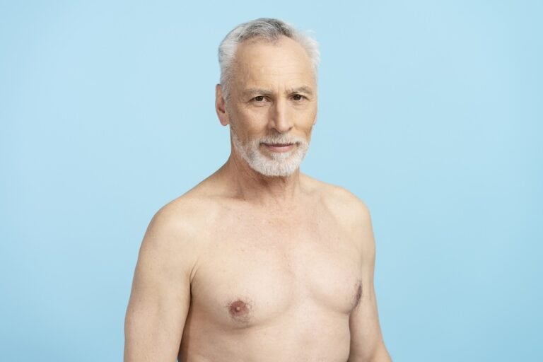 aged man shirtless with gynecomastia